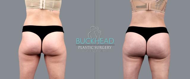 Brazilian Butt Lift result at Buckhead Plastic Surgery (Alan N. Larsen MD) in Atlanta, GA