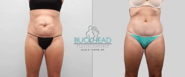 Tummy Tuck result at Buckhead Plastic Surgery (Alan N. Larsen MD) in Atlanta, GA
