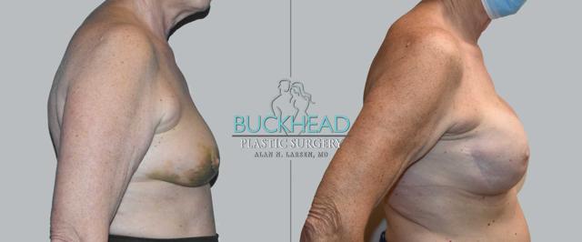 Breast Augmentation result at Buckhead Plastic Surgery (Alan N. Larsen MD) in Atlanta, GA