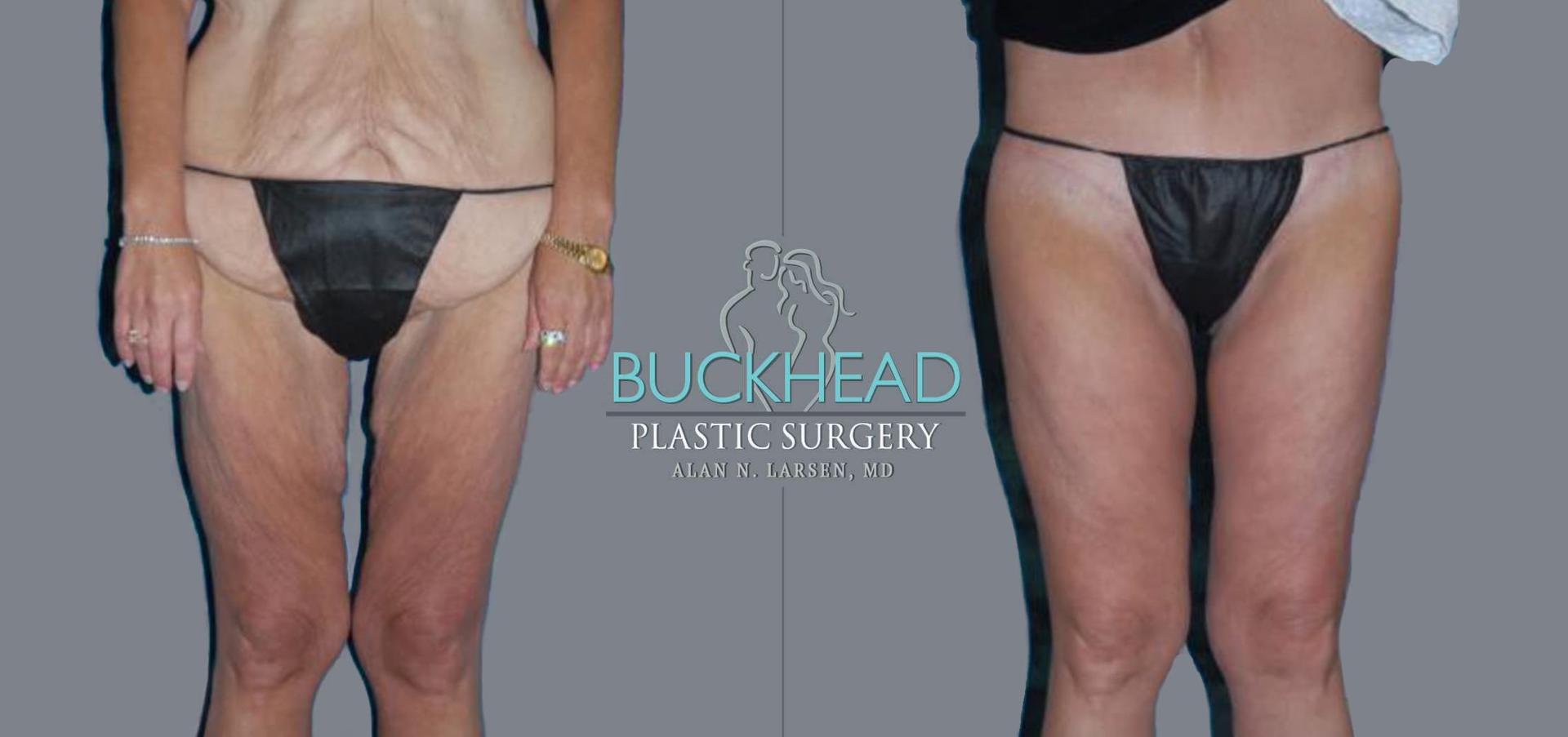 Buckhead Plastic Surgery (Alan N. Larsen MD) thigh lift result — Atlanta, GA