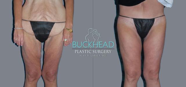 Thigh Lift result at Buckhead Plastic Surgery (Alan N. Larsen MD) in Atlanta, GA