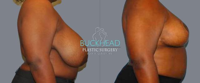 Breast Reduction result at Buckhead Plastic Surgery (Alan N. Larsen MD) in Atlanta, GA