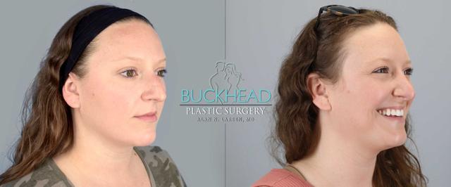 Ethnic Rhinoplasty result at Buckhead Plastic Surgery (Alan N. Larsen MD) in Atlanta, GA