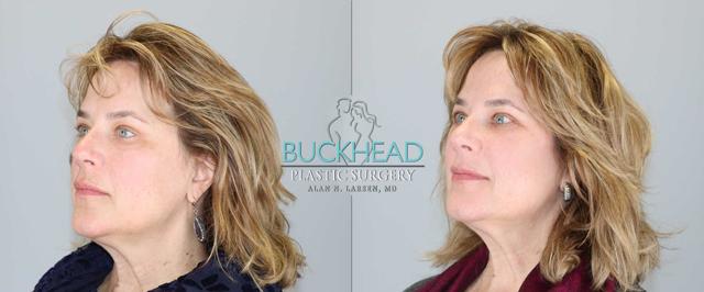 Blepharoplasty result at Buckhead Plastic Surgery (Alan N. Larsen MD) in Atlanta, GA