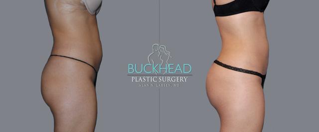 Brazilian Butt Lift result at Buckhead Plastic Surgery (Alan N. Larsen MD) in Atlanta, GA