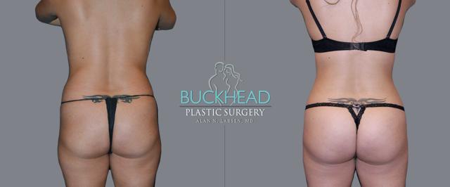 Brazilian Butt Lift result at Buckhead Plastic Surgery (Alan N. Larsen MD) in Atlanta, GA
