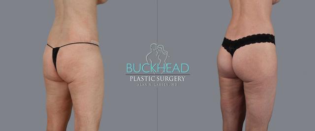 Brazilian Butt Lift result at Buckhead Plastic Surgery (Alan N. Larsen MD) in Atlanta, GA