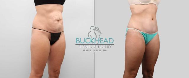 Tummy Tuck result at Buckhead Plastic Surgery (Alan N. Larsen MD) in Atlanta, GA