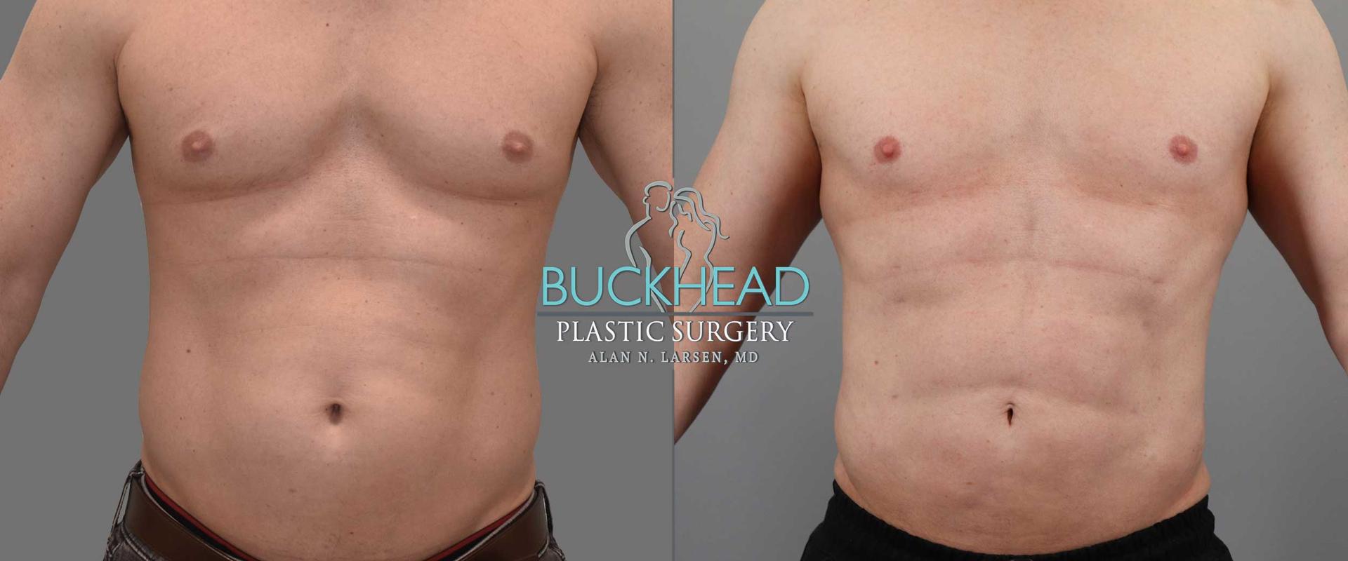 Buckhead Plastic Surgery (Alan N. Larsen MD) liposuction result — Atlanta, GA