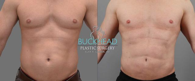Liposuction result at Buckhead Plastic Surgery (Alan N. Larsen MD) in Atlanta, GA