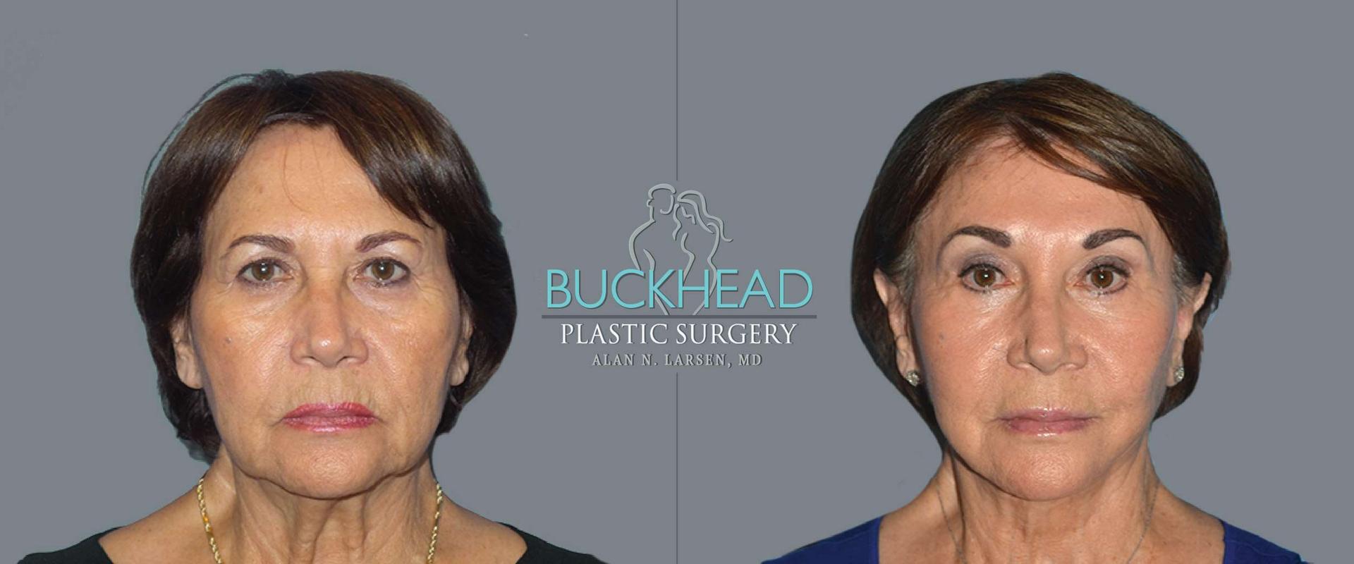 Buckhead Plastic Surgery (Alan N. Larsen MD) brow lift result — Atlanta, GA