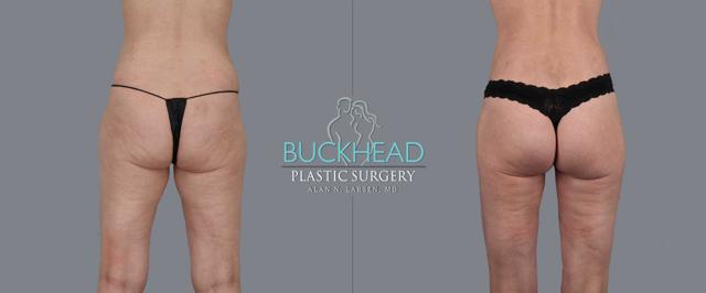 Brazilian Butt Lift result at Buckhead Plastic Surgery (Alan N. Larsen MD) in Atlanta, GA