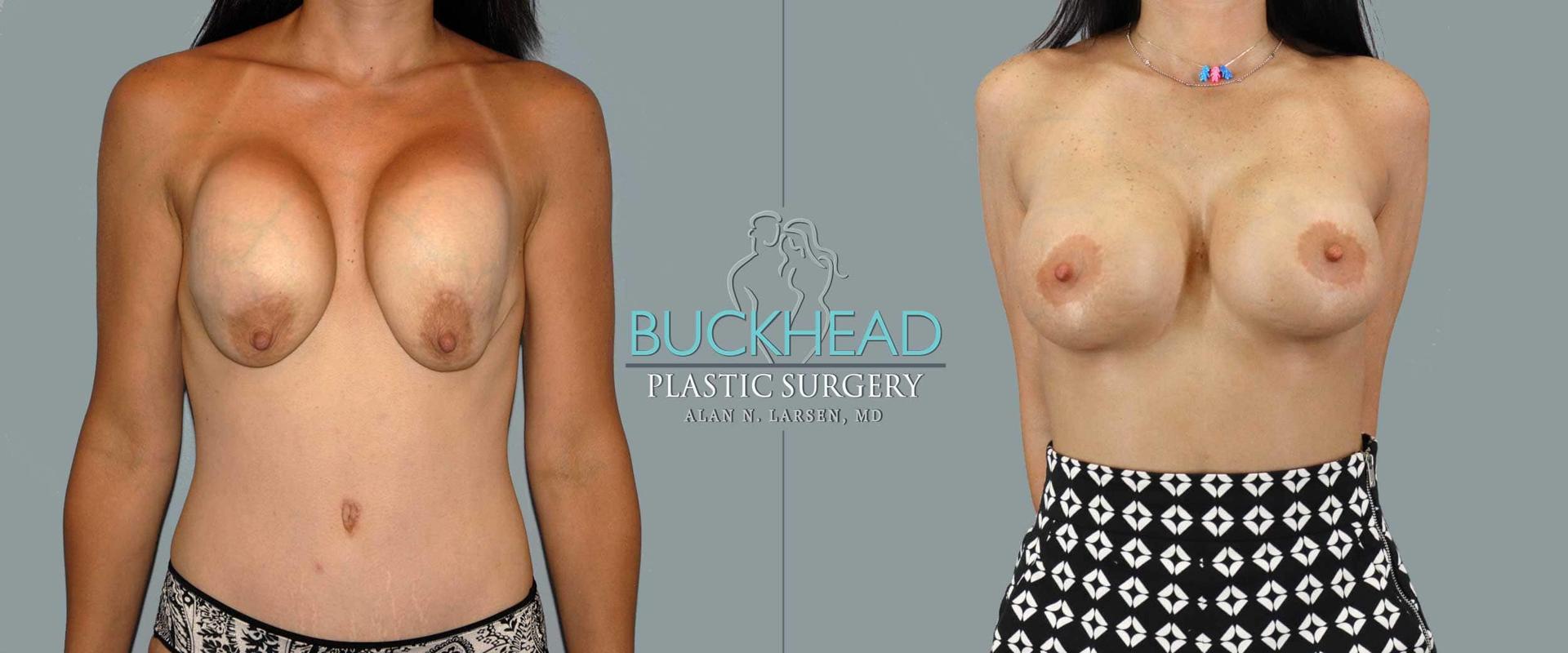 Buckhead Plastic Surgery (Alan N. Larsen MD) breast augmentation revision result — Atlanta, GA