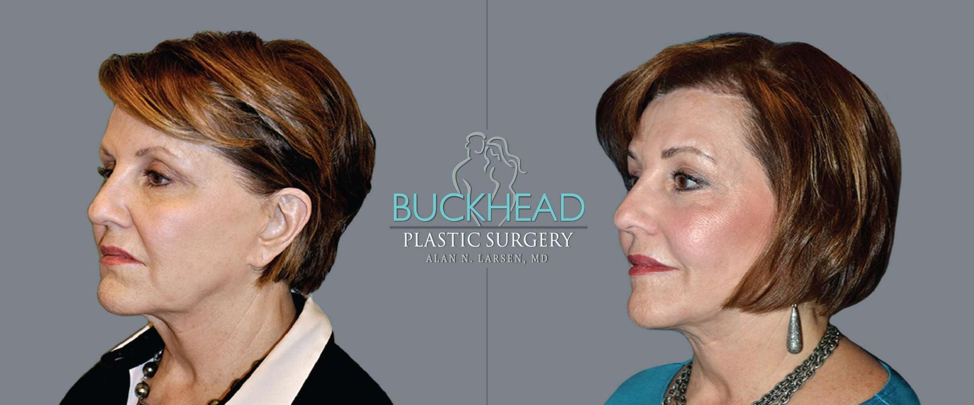 Buckhead Plastic Surgery (Alan N. Larsen MD) brow lift result — Atlanta, GA