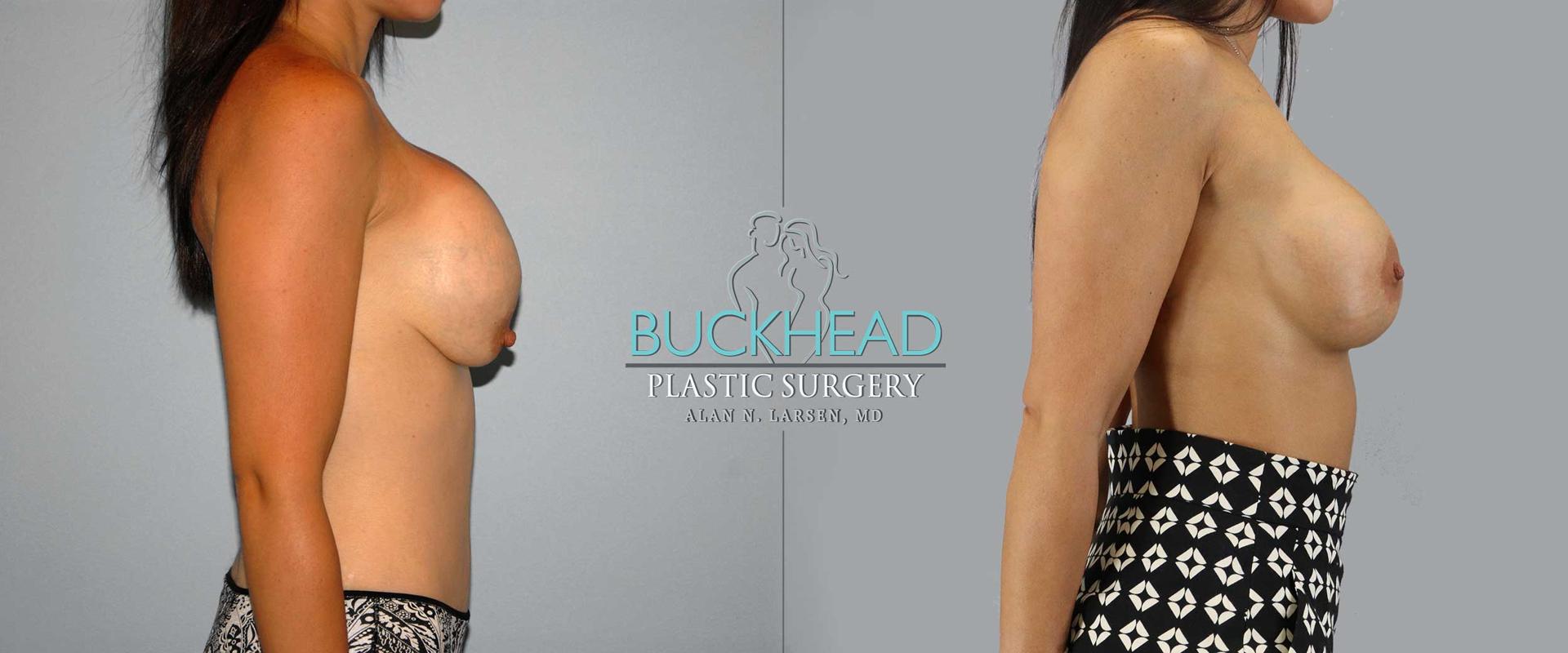 Buckhead Plastic Surgery (Alan N. Larsen MD) breast augmentation revision result — Atlanta, GA