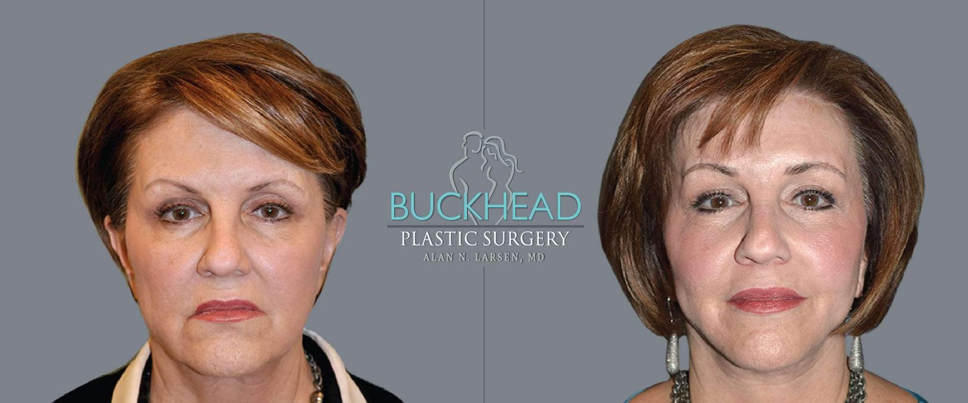 Buckhead Plastic Surgery (Alan N. Larsen MD) brow lift result — Atlanta, GA