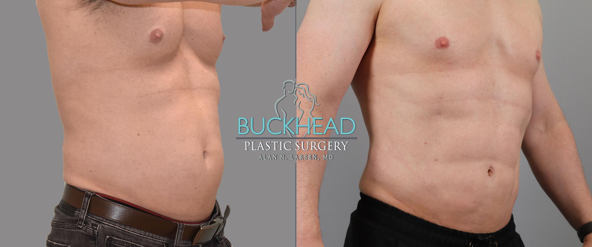 Buckhead Plastic Surgery (Alan N. Larsen MD) liposuction result — Atlanta, GA