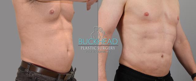 Liposuction result at Buckhead Plastic Surgery (Alan N. Larsen MD) in Atlanta, GA