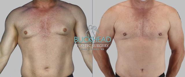 Gynecomastia Surgery result at Buckhead Plastic Surgery (Alan N. Larsen MD) in Atlanta, GA