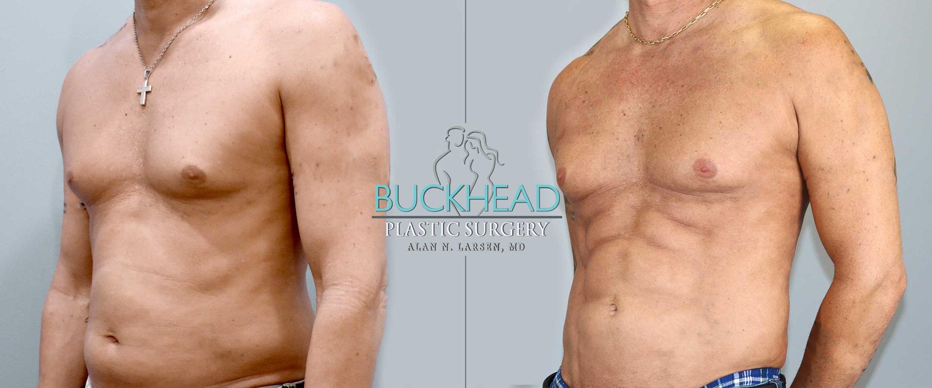 Buckhead Plastic Surgery (Alan N. Larsen MD) liposuction result — Atlanta, GA