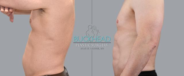 Liposuction result at Buckhead Plastic Surgery (Alan N. Larsen MD) in Atlanta, GA