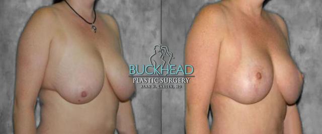 Breast Lift result at Buckhead Plastic Surgery (Alan N. Larsen MD) in Atlanta, GA