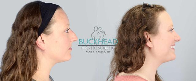 Ethnic Rhinoplasty result at Buckhead Plastic Surgery (Alan N. Larsen MD) in Atlanta, GA