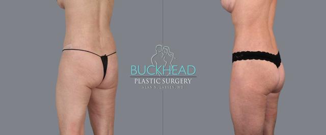 Brazilian Butt Lift result at Buckhead Plastic Surgery (Alan N. Larsen MD) in Atlanta, GA