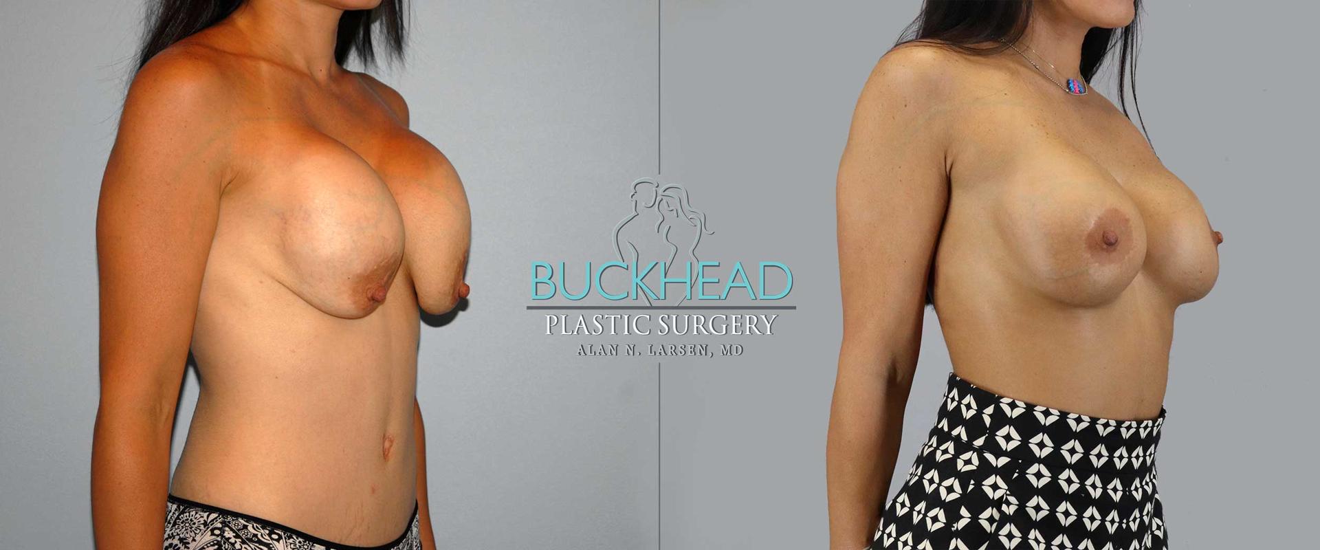 Buckhead Plastic Surgery (Alan N. Larsen MD) breast augmentation revision result — Atlanta, GA