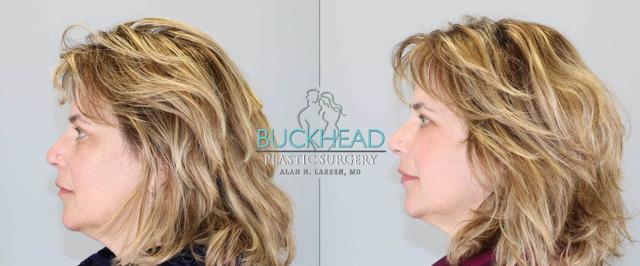 Blepharoplasty result at Buckhead Plastic Surgery (Alan N. Larsen MD) in Atlanta, GA