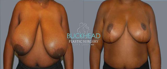 Breast Reduction result at Buckhead Plastic Surgery (Alan N. Larsen MD) in Atlanta, GA