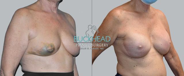 Breast Augmentation result at Buckhead Plastic Surgery (Alan N. Larsen MD) in Atlanta, GA