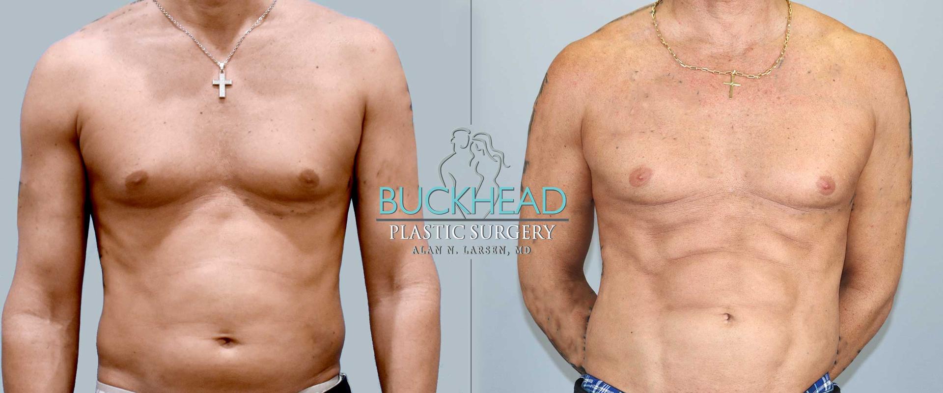 Buckhead Plastic Surgery (Alan N. Larsen MD) liposuction result — Atlanta, GA