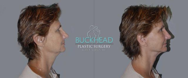 Neck Lift result at Buckhead Plastic Surgery (Alan N. Larsen MD) in Atlanta, GA