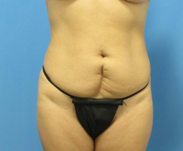 Mommy Makeover before at Michael C. Cheung, MD in Fort Lauderdale, FL