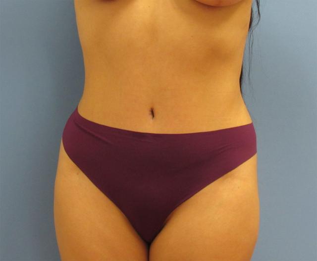 Mommy Makeover after at Michael C. Cheung, MD in Fort Lauderdale, FL