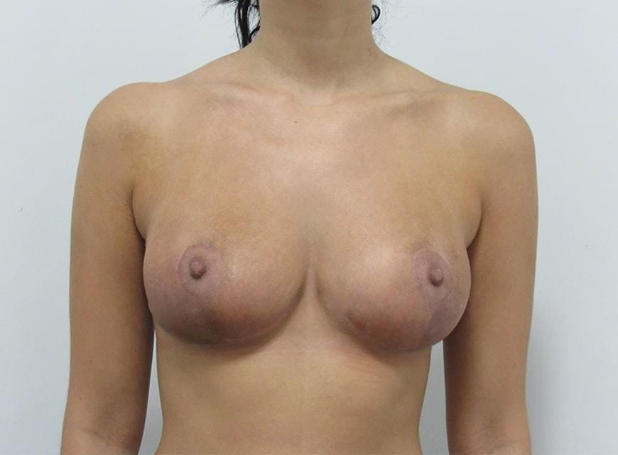 Michael C. Cheung, MD breast lift after — Fort Lauderdale, FL