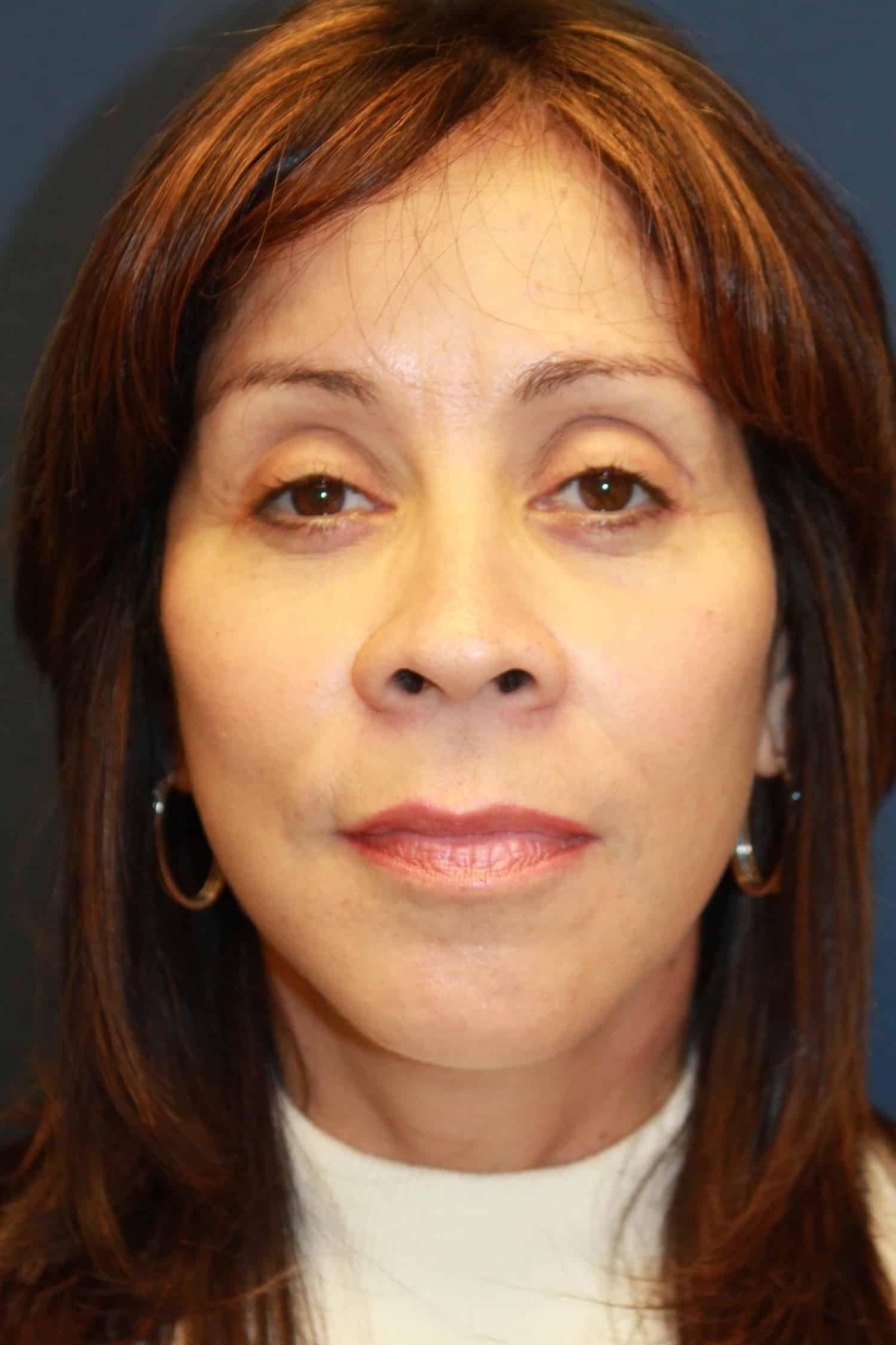 Hillcrest Plastic Surgery (Kenrick Spence, MD) facelift after — Orlando, FL