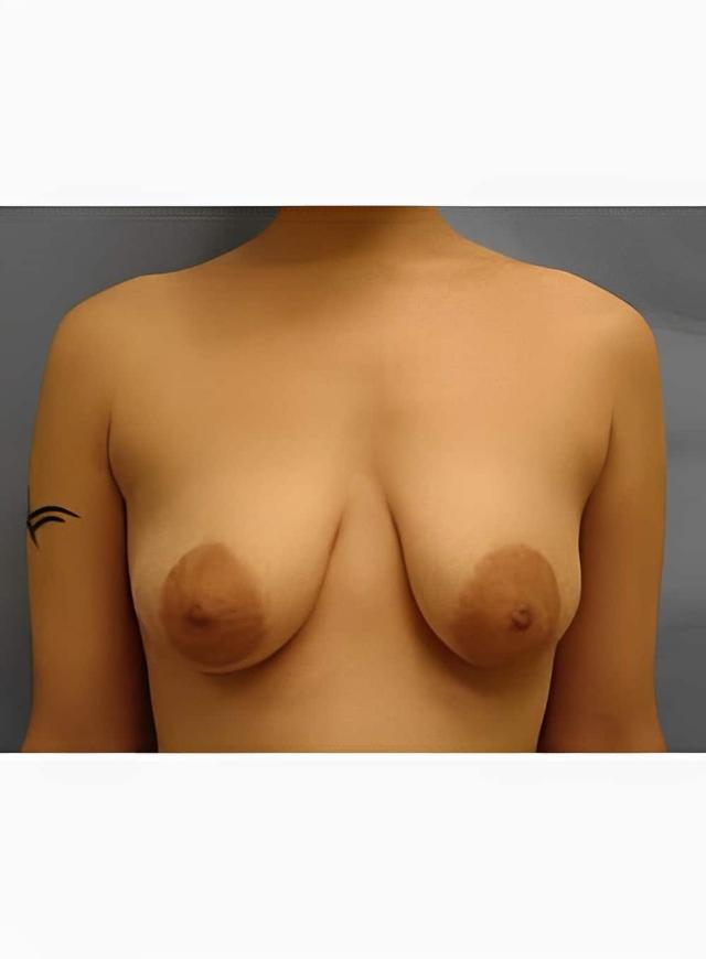 Breast Lift before at Hillcrest Plastic Surgery (Kenrick Spence, MD) in Orlando, FL