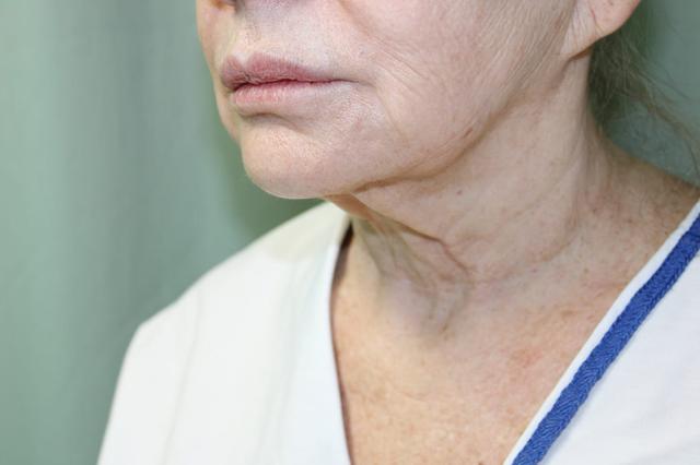 Deep Plane Facelift before at Hillcrest Plastic Surgery (Kenrick Spence, MD) in Orlando, FL