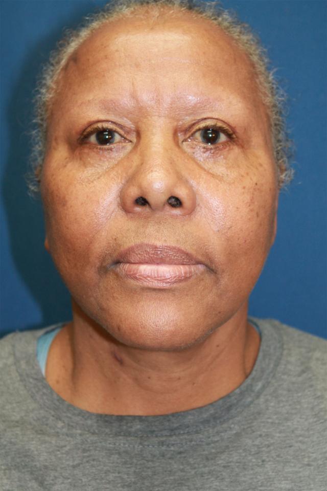 Neck Lift after at Hillcrest Plastic Surgery (Kenrick Spence, MD) in Orlando, FL