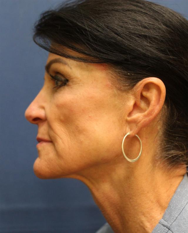 Deep Plane Facelift before at Hillcrest Plastic Surgery (Kenrick Spence, MD) in Orlando, FL