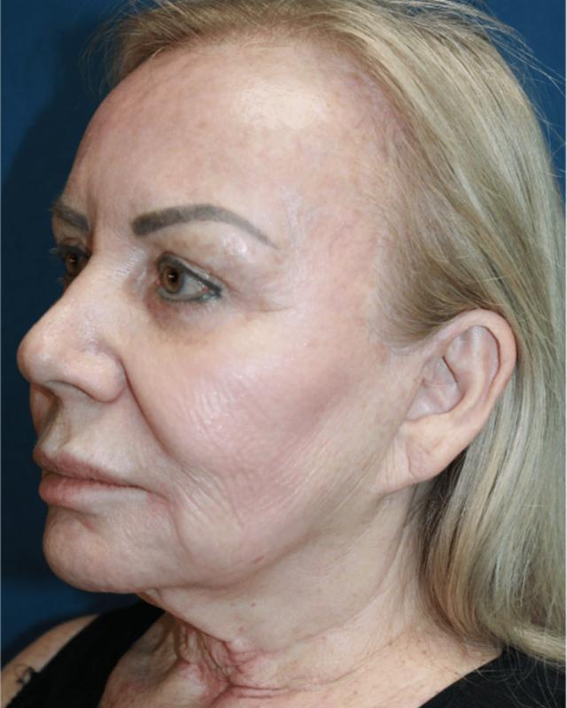 Deep Plane Facelift before at Hillcrest Plastic Surgery (Kenrick Spence, MD) in Orlando, FL