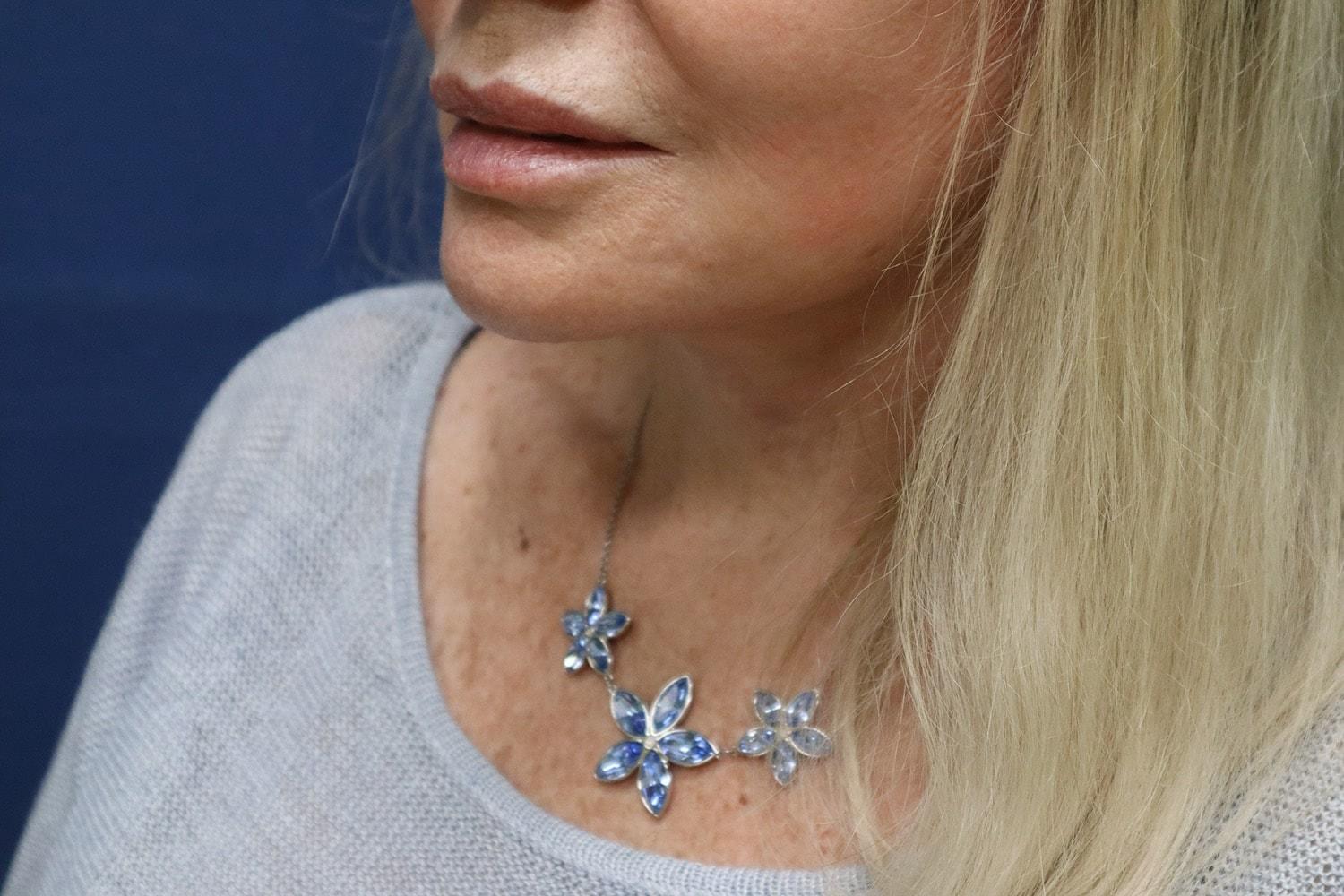Hillcrest Plastic Surgery (Kenrick Spence, MD) facelift after — Orlando, FL
