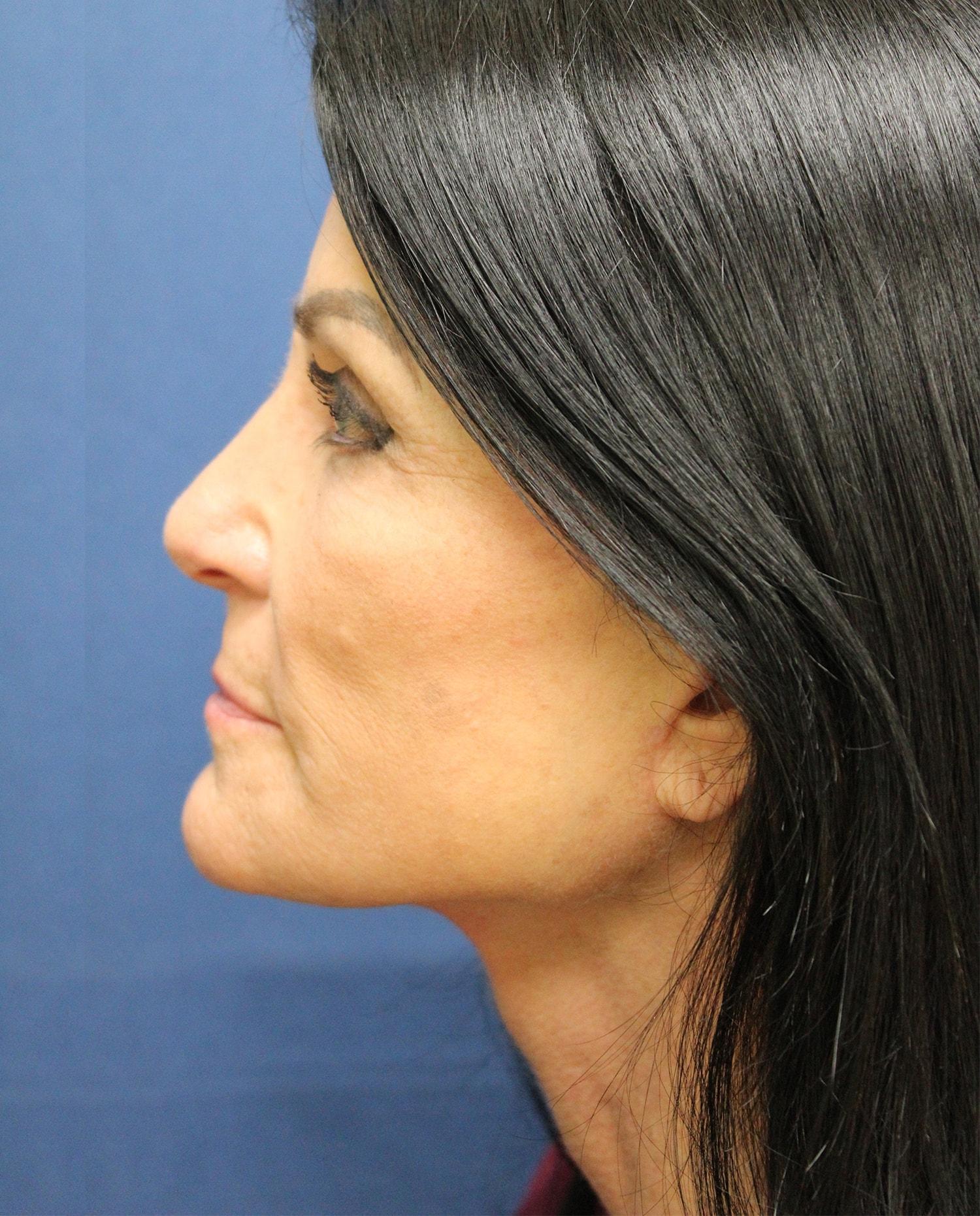 Hillcrest Plastic Surgery (Kenrick Spence, MD) facelift after — Orlando, FL