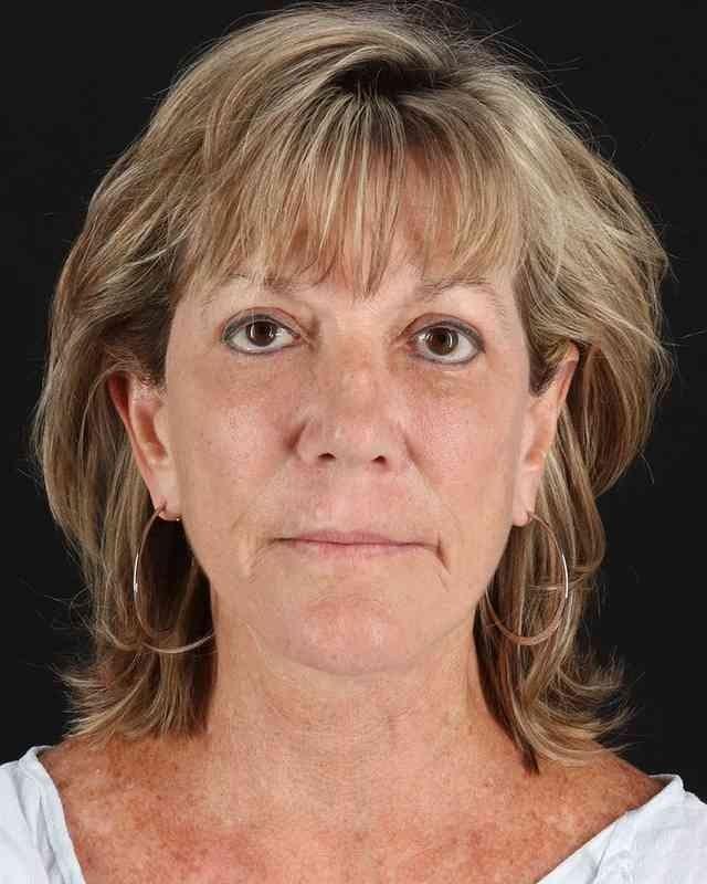 Sean Boutros, MD facelift after — Houston, TX
