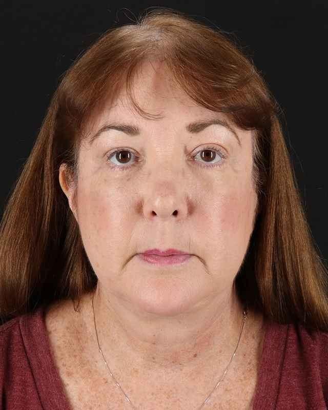 Sean Boutros, MD facelift after — Houston, TX
