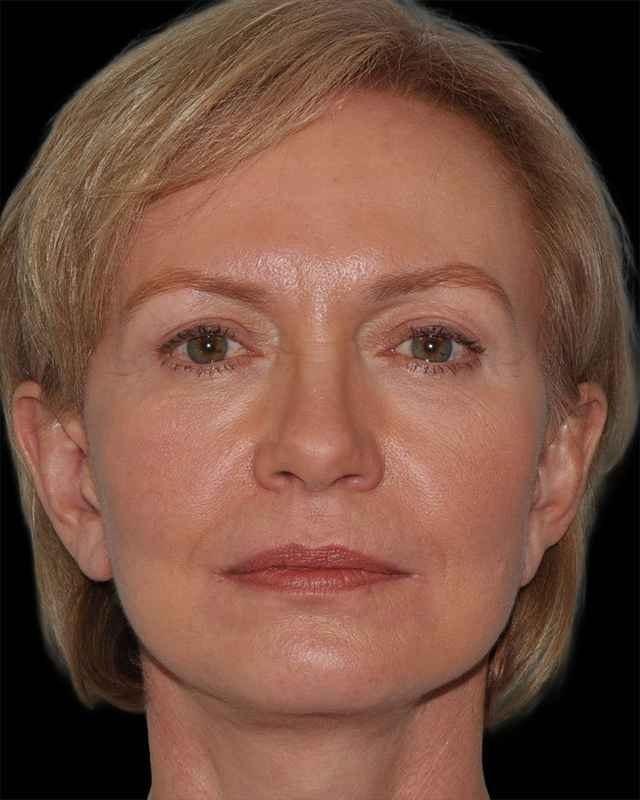 Sean Boutros, MD facelift after — Houston, TX