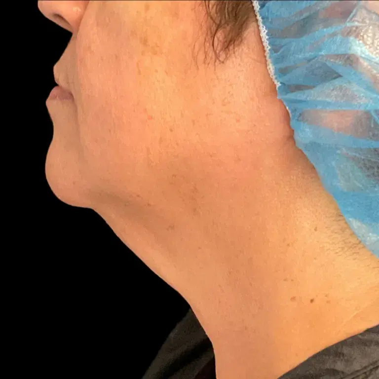 Miami Plastic Surgery skin tightening after — Miami, FL