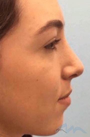 Miami Plastic Surgery rhinoplasty after — Miami, FL